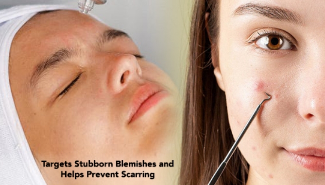 Click to view picture 2 of Deluxe Microderm Blemish and Pore Cleaning System -  Smoother, Brighter Skin